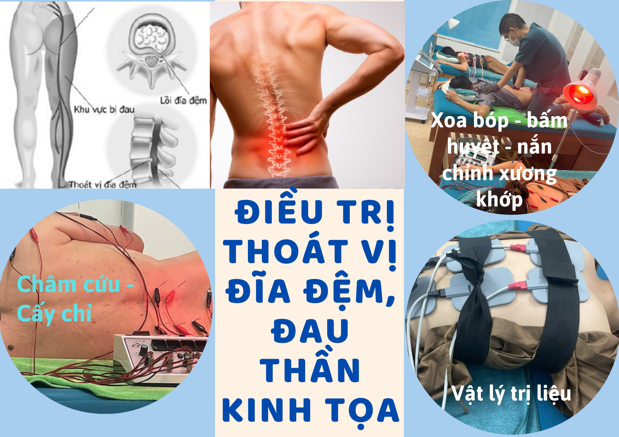 Điều trị thoát vị đĩa đệm bằng vật lý trị liệu và châm cứu